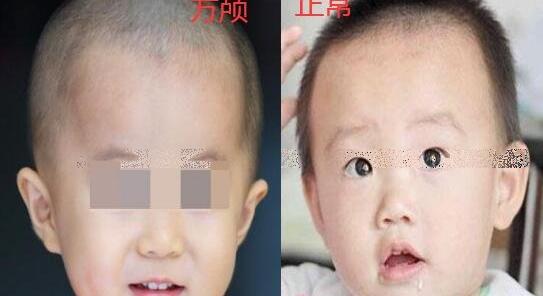 正常头型和方颅的区别图片，前额突出脑袋方方像寿星(是佝偻病)