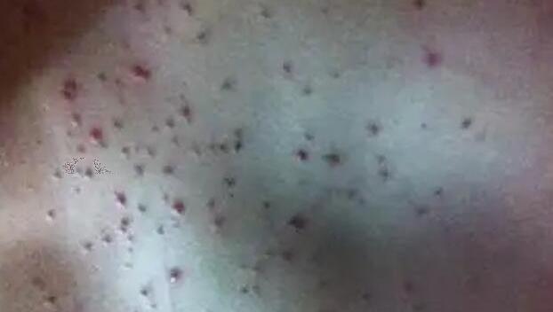 艾滋病初期小红点照片，特征和斑丘疹/玫瑰丘疹相同(不痒不痛)