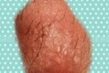 hpv男性感染后的表现图片，警惕丝状疣/扁平疣/尖锐湿疣的症状