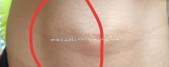 男性艾滋病的10个征兆，淋巴结肿大/生Z器疱疹(附病人真实照片)