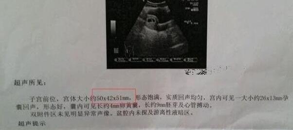 生男女其实看孕囊很准三个数据，6-7周的孕囊长条形是男宝
